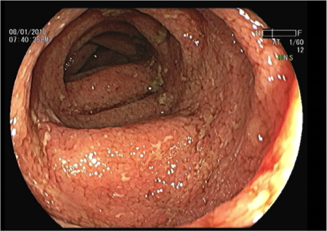 ¿Cómo manejar las enfermedades inflamatorias del intestino?